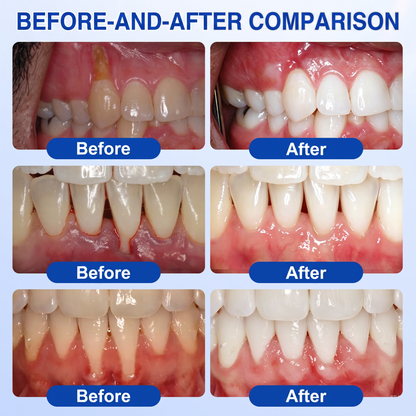 🦷𝑷𝒖𝒓𝒆𝒍𝒐𝒓𝒂® GumRevive periodontal repair gel